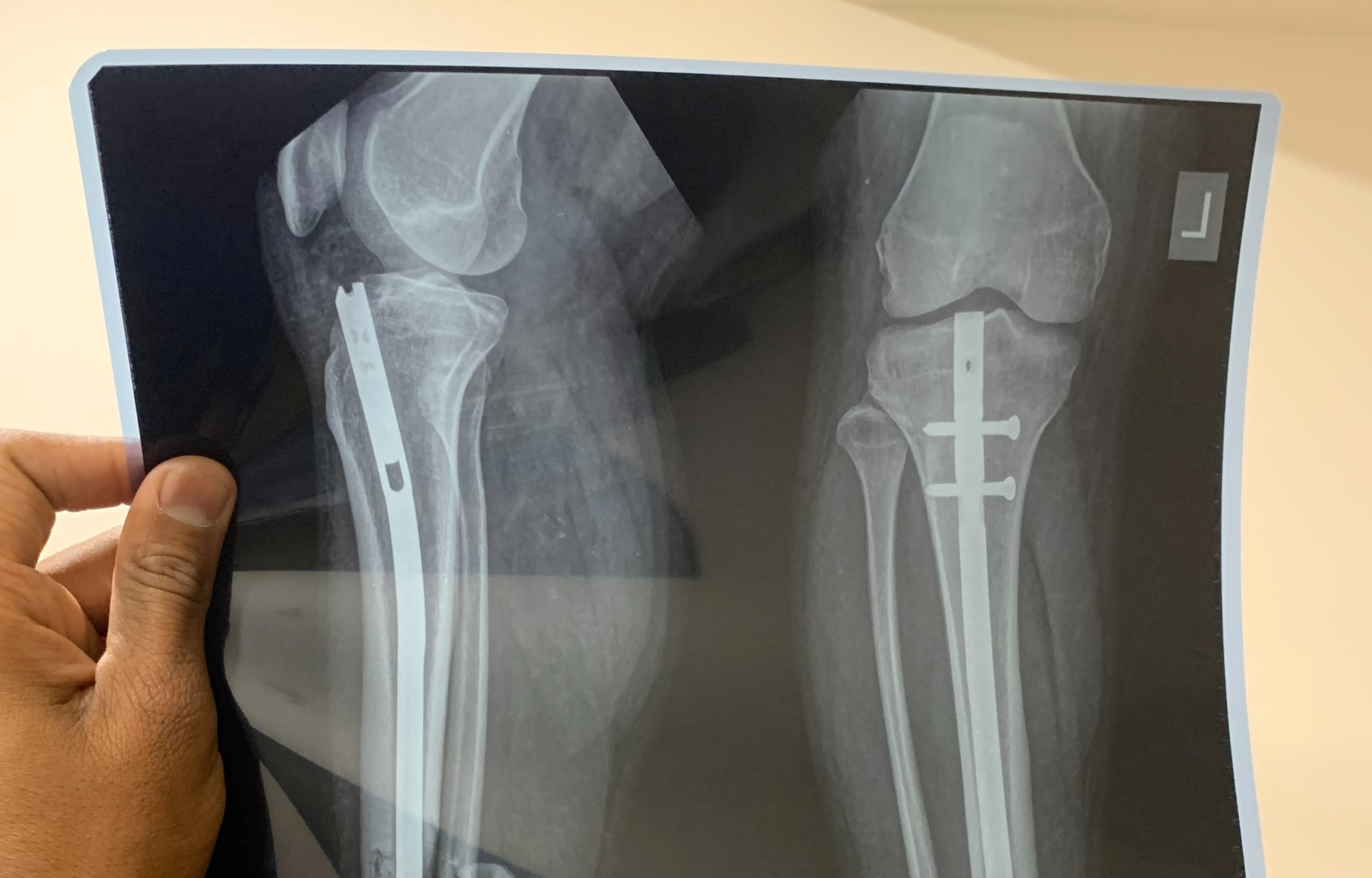 Röntgenaufnahme Beine